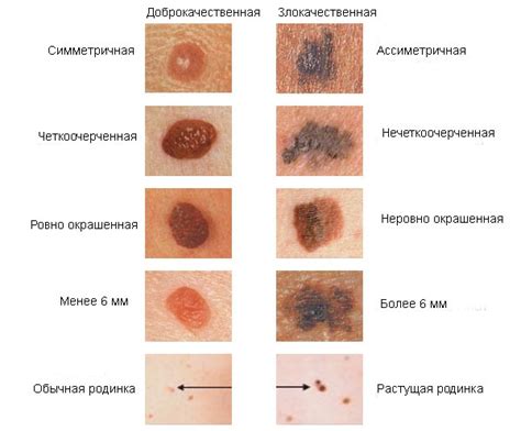 Меланома | lemur59.ru