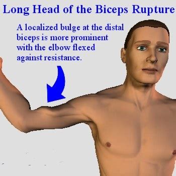 Shoulder Biceps Tendon Tear: Types, Causes, Symptoms, Treatments ...