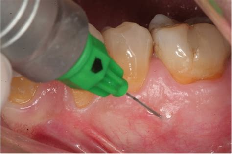 intraosseous injections news dentagama