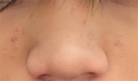 [acne] i cant get rid of these bumps on my skin : r/Skincare_Addiction