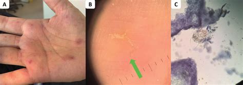 Typical lesions of ordinary scabies. (A) Scabies lesions on the palm of ...