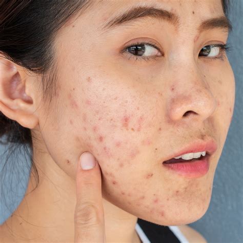 product  helped fade  post acne dark spots veenourish