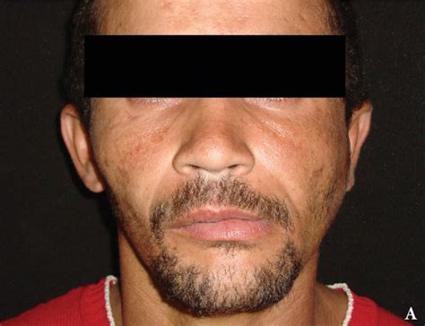 Table 1 from TMJ ́s Posterolateral Dislocation with Tympanic Plate ...