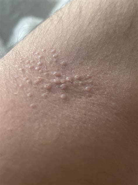Does anyone know what these bumps on my arm are they are itchy, they