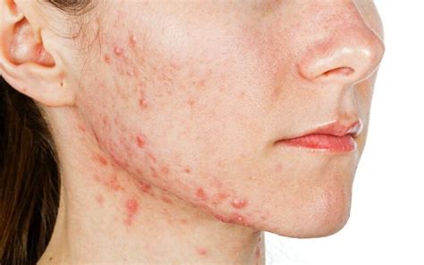 Как лечить демодекоз - Coolaser Clinic
