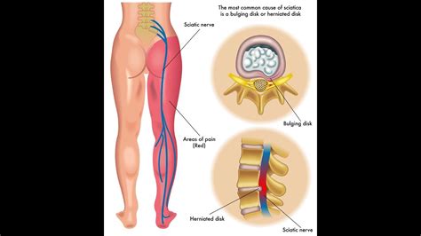 Back surgery; DISECTOMY: L5, S1. Nerve pain GONE! - YouTube