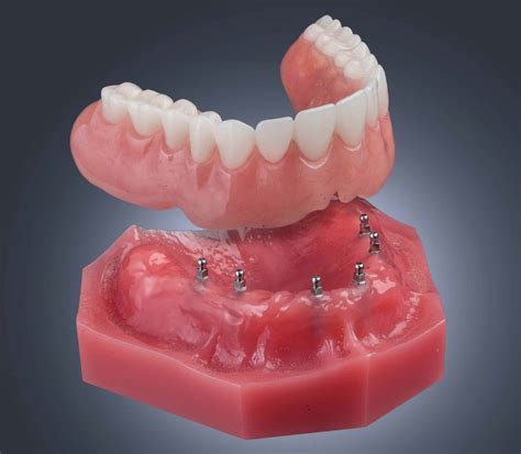 how much is hair implant surgery 5