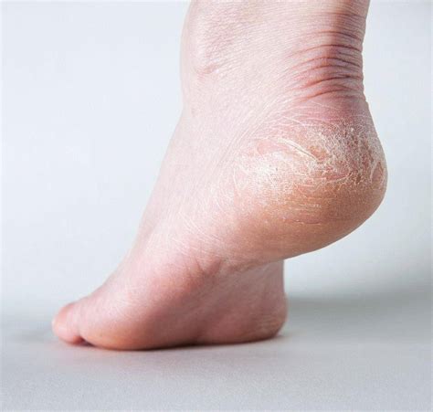 Натоптыши шпоры трещины на пятках - фото презентация