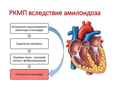 Рестриктивная кардиомиопатия - online presentation