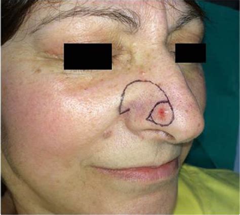 extended rotation flap  reconstruction  partial thickness defects