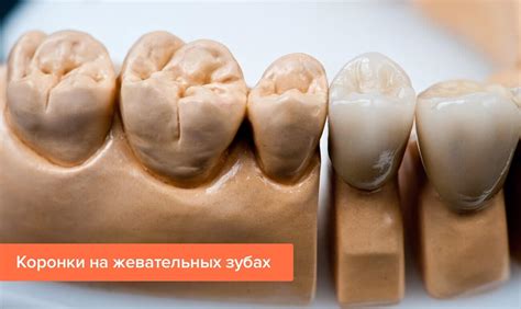 Какие коронки лучше ставить на жевательные зубы