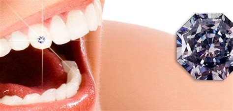 Zubni nakit - Ordinacija Dentalne Medicine