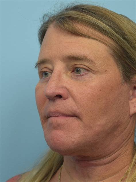Before & After Facial Feminization Surgery Bellaire | Face Forward