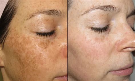 BBL Laser Treatment - Eden Medical Clinic