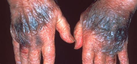 Bruising Archives - Academic Dermatology of Nevada