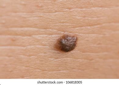 Dermal Nevus