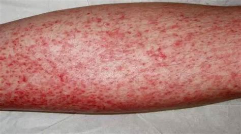eosinophilia definition  eosinophilia