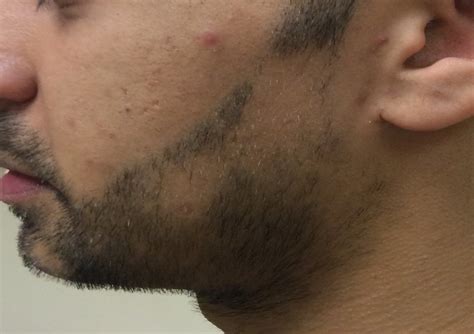 A Case Study on PRP Treatment and its Successful Results for Treating ...
