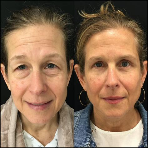 Blepharoplasty Before and After: A Way to a Bright Look - Bellezie