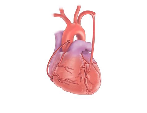 coronary artery bypass surgery safe exercise guidelines