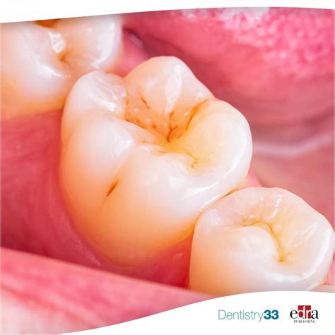 peptide  remineralize carious lesions dentistry