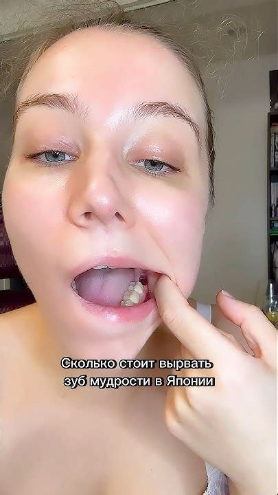 Сколько стоит вырвать зуб мудрости в Японии. Цена указана с учетом ...