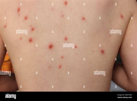 chickenpox spots and scabs on a childs back and tummy Stock Photo - Alamy