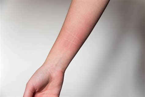 Dermografismo: causas y tratamiento - Salud Savia