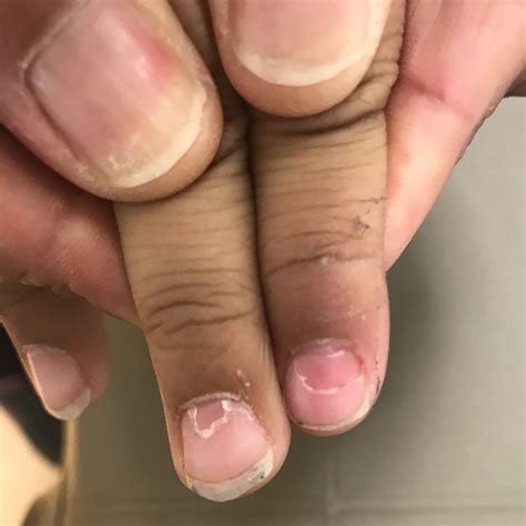 how to know if nail matrix is damaged