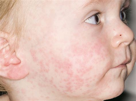 Roseola vs. measles rash: What is the difference?