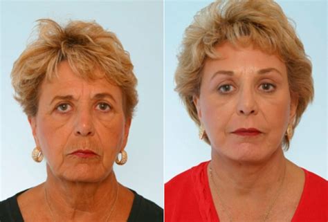 Facial Plastic Surgery Before & After Photos | Dr. Vitenas