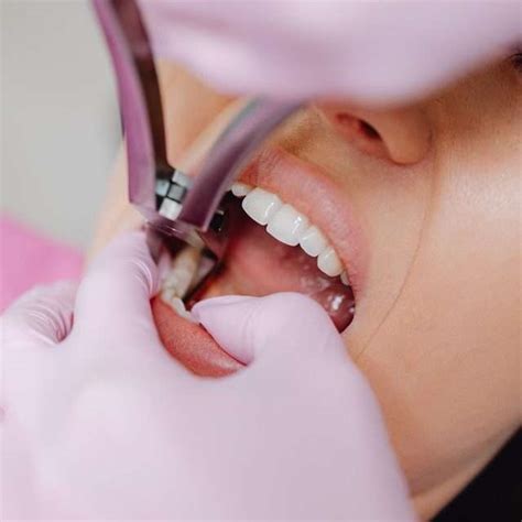 how long do wisdom teeth take to heal