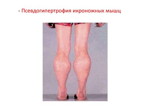 Миопатия Дюшена - презентация онлайн