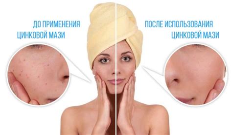 Цинковая мазь: инструкция по применению, от чего помогает, состав ...