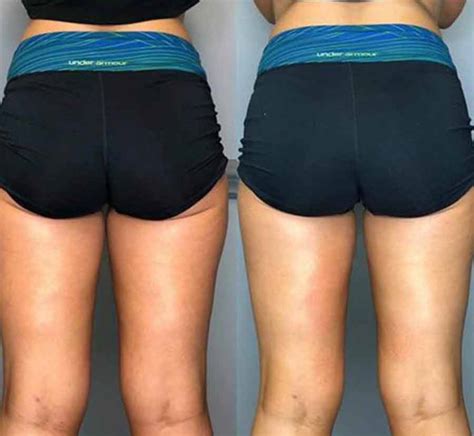 Before and After Photos of Clients in Northridge, CA