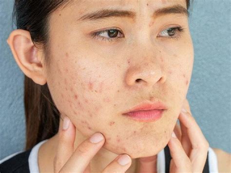 acne prevention simple tips    follow  avoid  skin