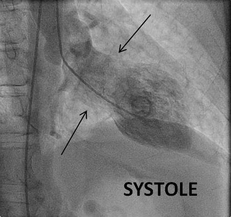 Stress-induced cardiomyopathy | BMJ Case Reports