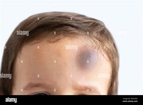 bruise  wound child forehead  res stock photography  images alamy