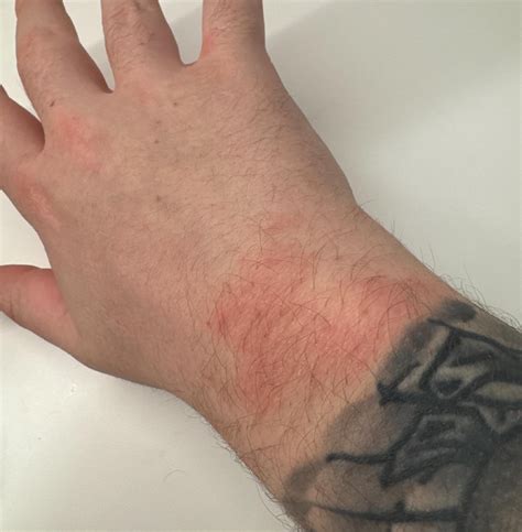 Does this look like Scabies? : r/scabies