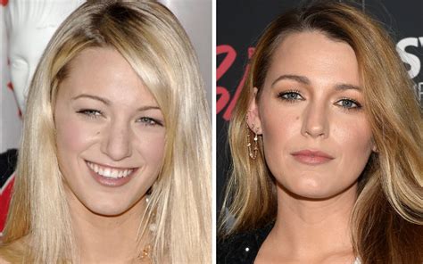 Unraveling The Mystique Of Celebrities Panda Eyes How Eyelid Rejuvenation Transformed Hollywoods Favorites