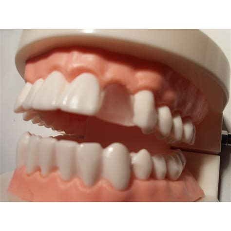 how to temporarily fix a cracked tooth