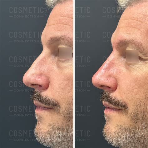 evaluating nose fillers cosmetic connection