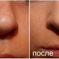 Тональный крем Vichy NormaTeint для проблемной кожи - «Очень хороший ...