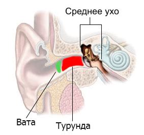 Турунда в ухо: как сделать правильно, фото процесса изготовления