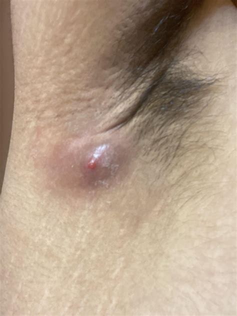 Advice on what to do for armpit boil : r/Hidradenitis