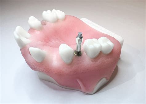 Measuring dental implant stability at the abutment level - Osstell®