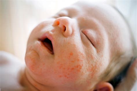 Neonatal Acne On Back