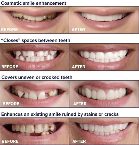 Snap-On Smile | #1 Dentist in Bridgewater