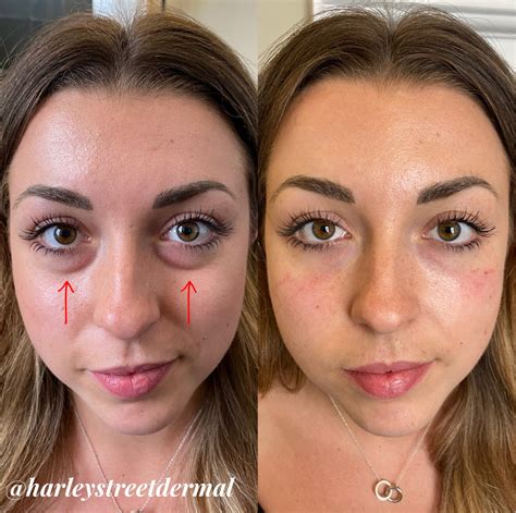 Dark Bags Under Eyes Treatment