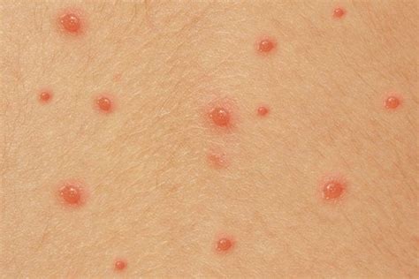 Chicken Pox in Babies and Toddlers | Signs, Symptoms & Treatments ...